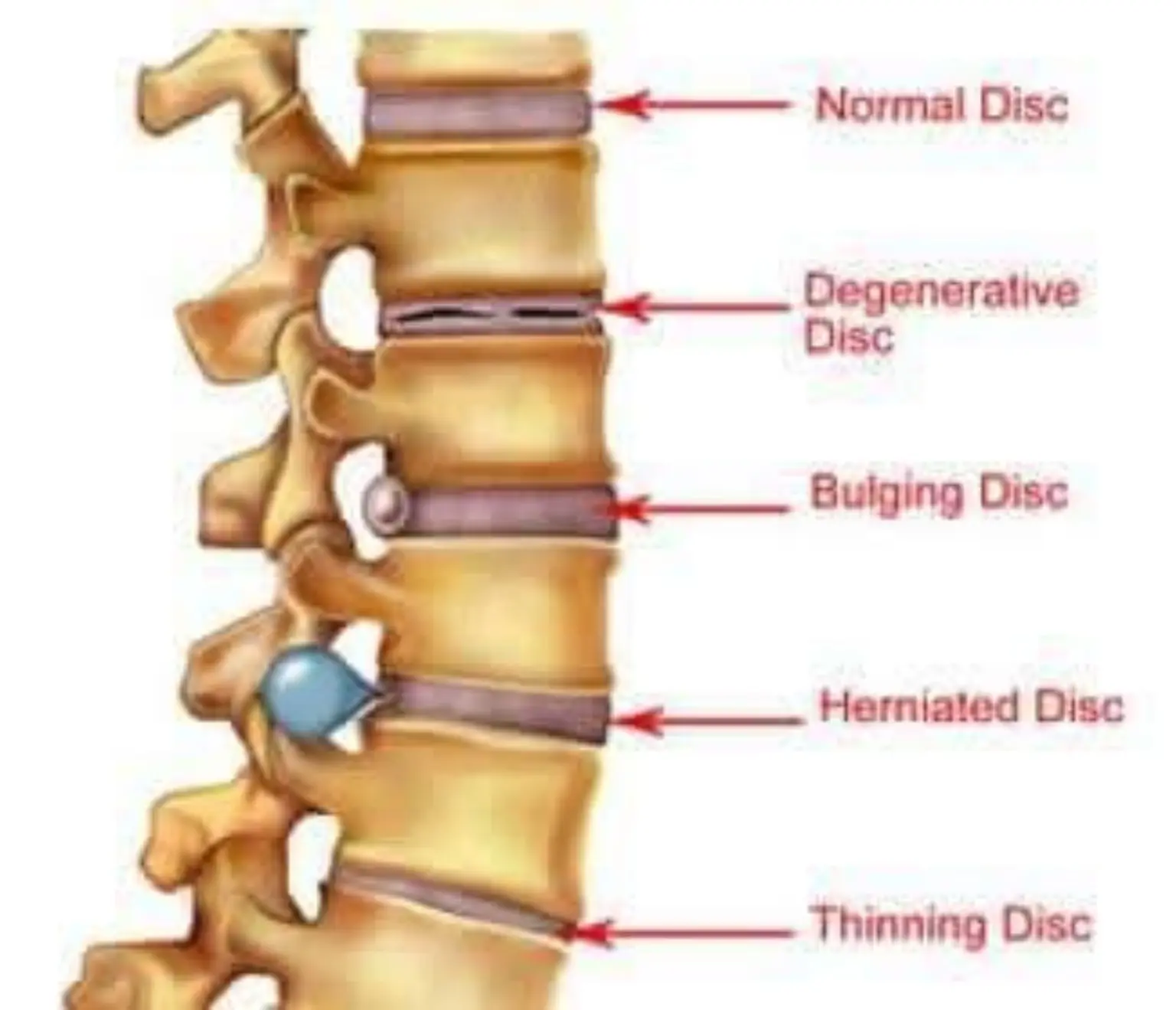 spine_disc_compressed