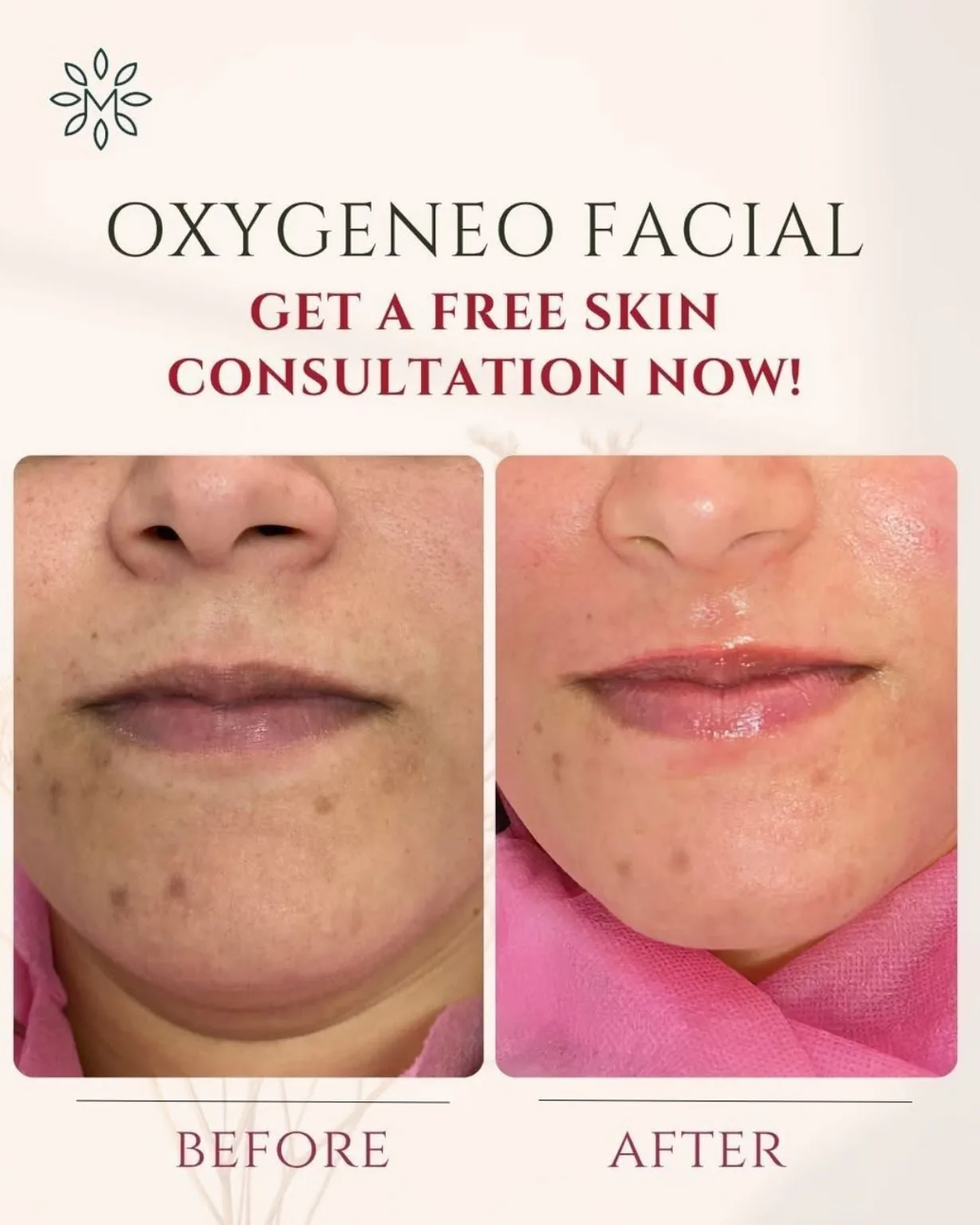 oxygeneo_facial